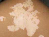 散发型白癜风怎么治疗好