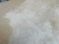 白癜风对患者有哪些危害