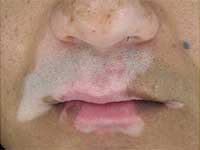 怎么治疗男性白癜风