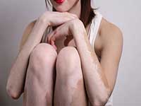 散发型白癜风有哪些病因