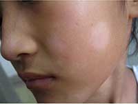 女孩脸上长白癜风有什么危害