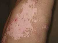 腿部出现白癜风的原因是什么