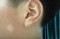 导致散发型的白癜风有哪些病因